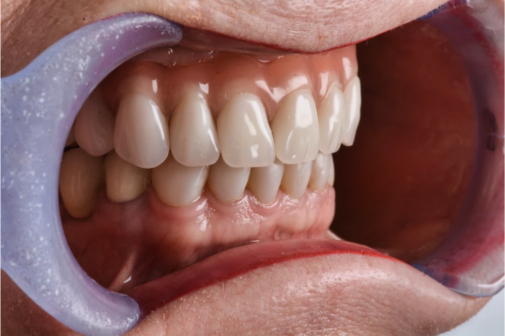 Premiumprothese im Mund mit natürlicher Zahnästhetik und hochwertiger Verarbeitung.