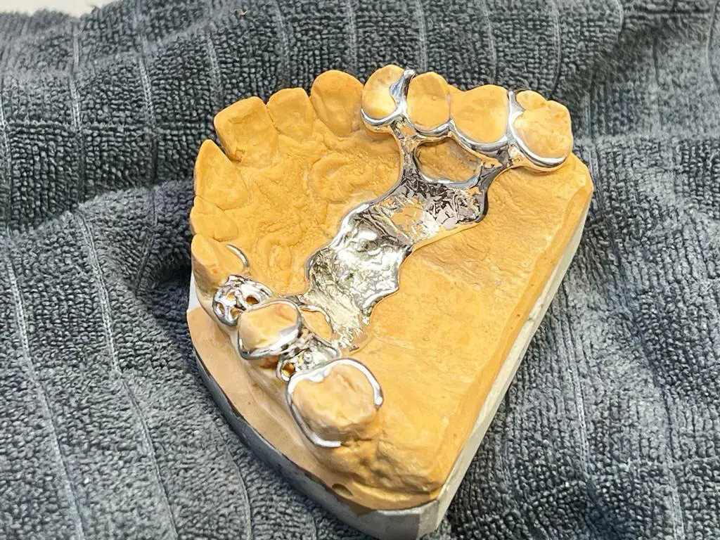 Oberkiefer-Modellguss mit transversalem Bügel – Ihr analoges Partnerlabor für Zahntechnik in Klagenfurt, Villach & Kärnten