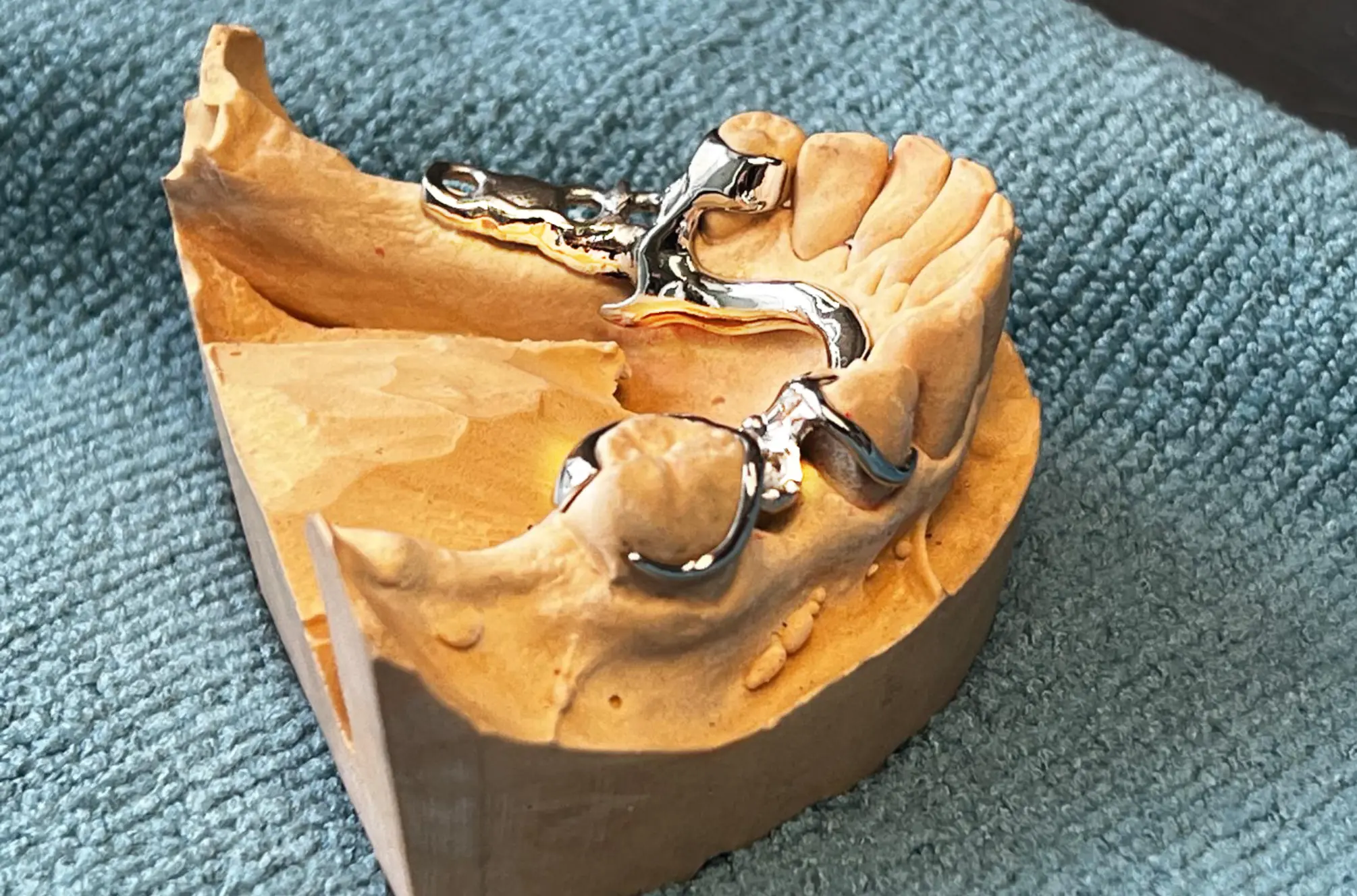 Unterkiefer-Modellguss analog gefertigt – Ihr Partnerlabor für Dentallabore in Innsbruck & Tirol