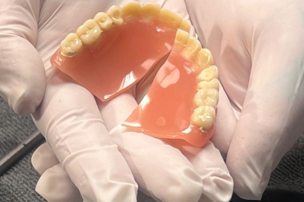 Gebrochene Zahnprothese vor der Reparatur im Dentallabor in Wien