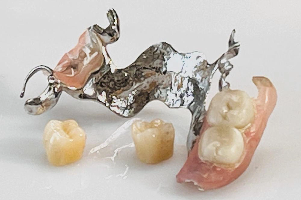 Modellguss Prothese mit zwei ausgebrochenen Zähnen vor Reparatur im Zahnlabor Wien