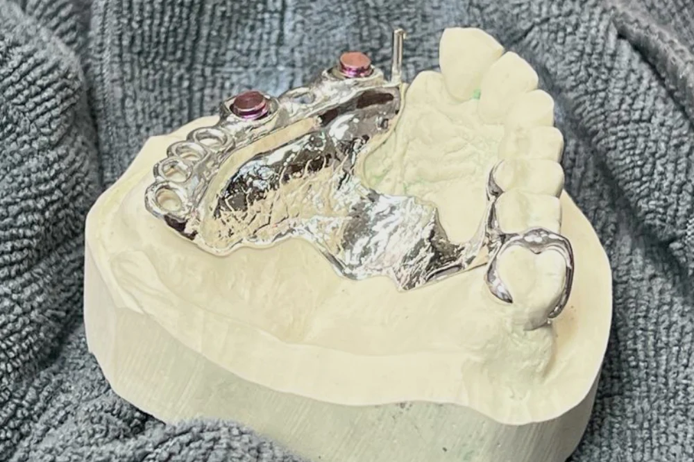 Dreigliedrige VMK Keramikbrücke aus dem Dentallabor in Wien