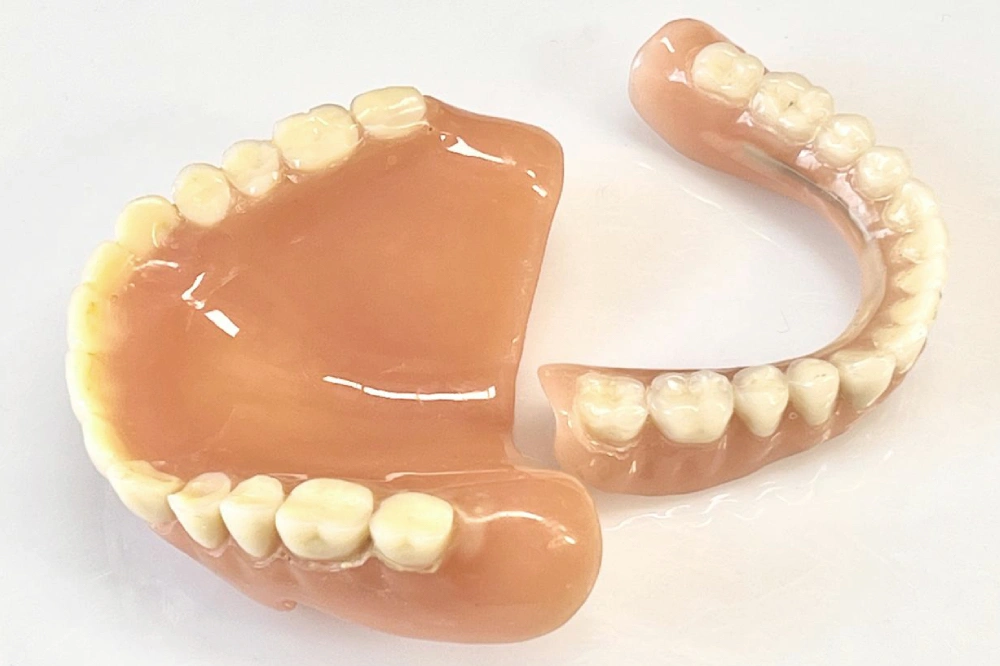 Gebrochene oder gesprungenen Zahnprothese vor der Reparatur im Dentallabor in Wien