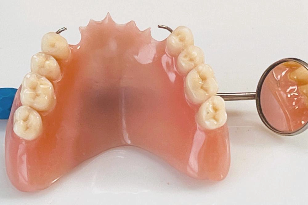 Lockere Zahnprothese Oberkiefer vor Anpassung und Unterfütterung im Dentallabor Wien