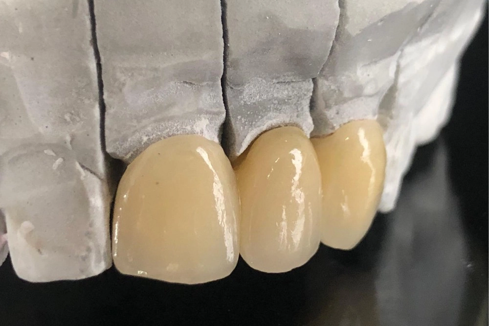 Dreigliedrige VMK Keramikbrücke aus dem Dentallabor in Wien