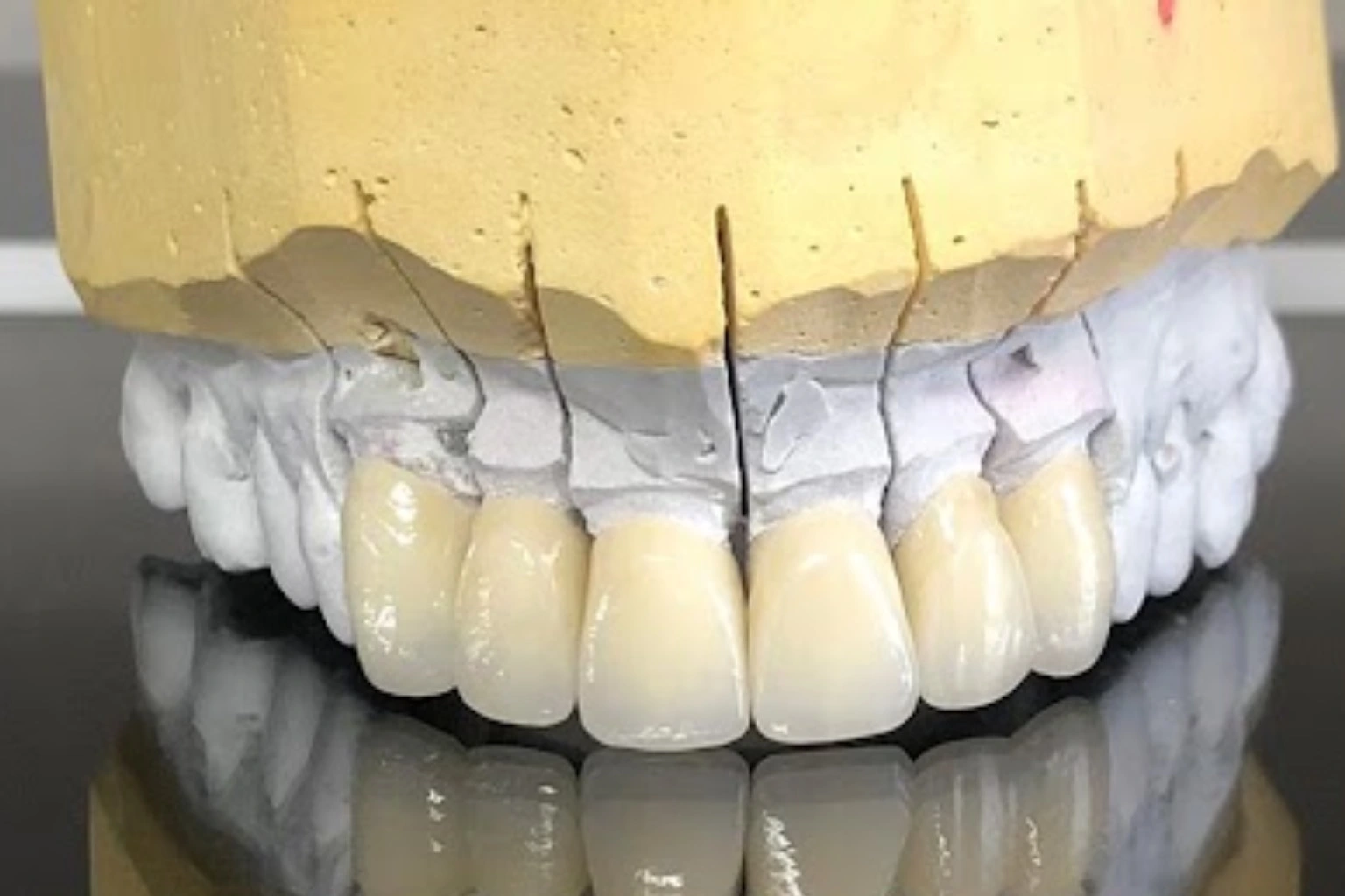 Oberkiefer Modellgussprothese ohne Klammern – passgenaue Zahntechnik Wien